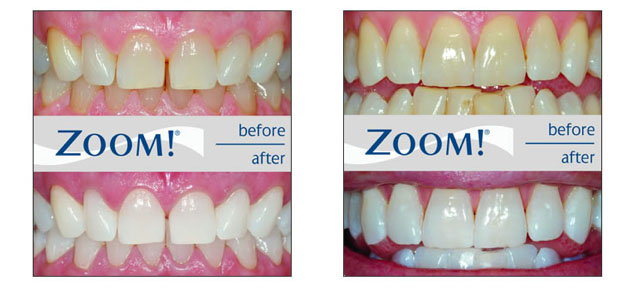 Richmond Road Dental Philips Zoom