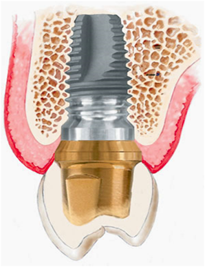 Richmond Road Dental Implants